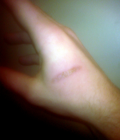 Toaster Oven Burn