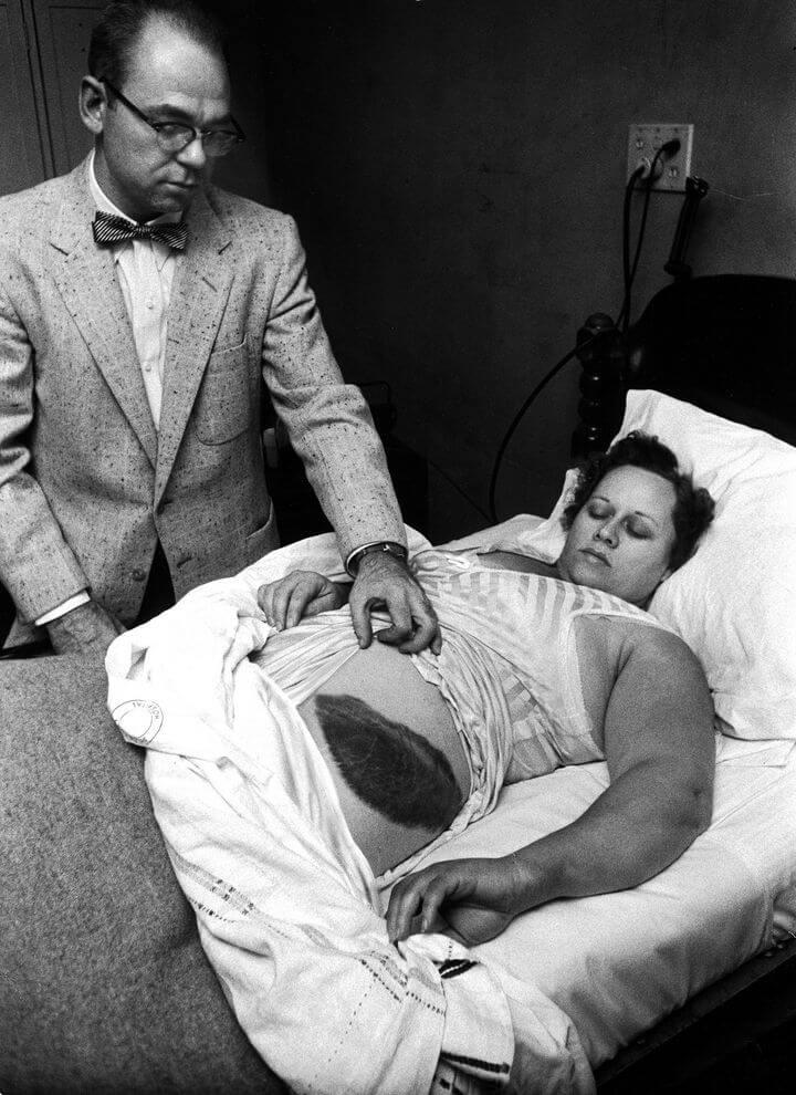 Ann Hodges and her meteor bruise